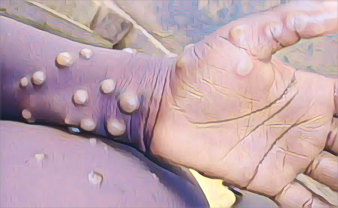 Mpox outbreak in Zimbabwe